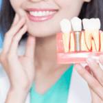dental_implants_Bradenton_dentist