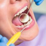 Tooth Extractions in Lakewood Ranch