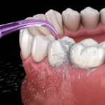 Gum Contouring