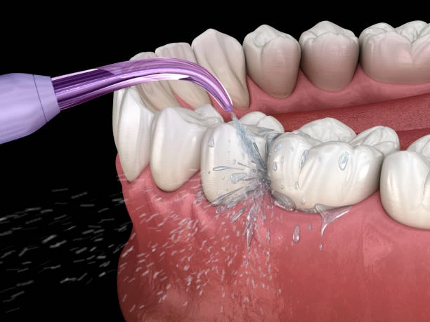 Gum Contouring