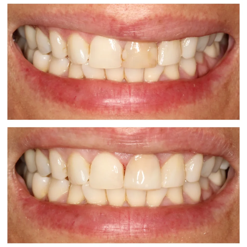 Filling Front Tooth