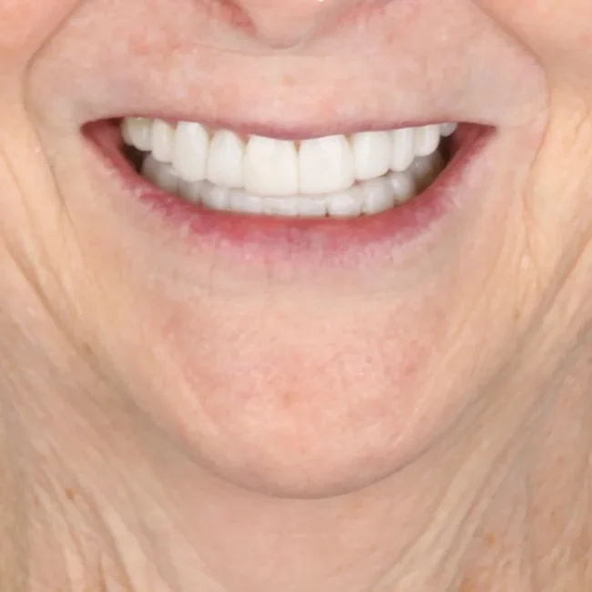 Teeth Whitening