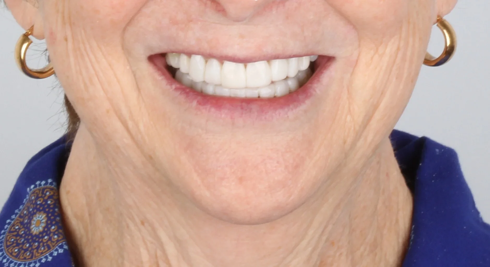 Teeth Whitening